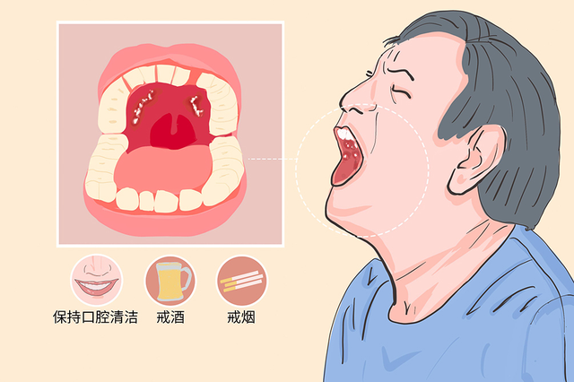 杭州御和堂中医院：口腔卫生与口腔癌有什么关系？