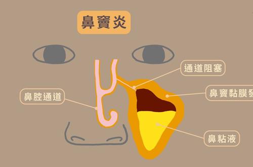 鼻窦炎鼻子流血是什么原因引起的?杭州老中医告诉你！