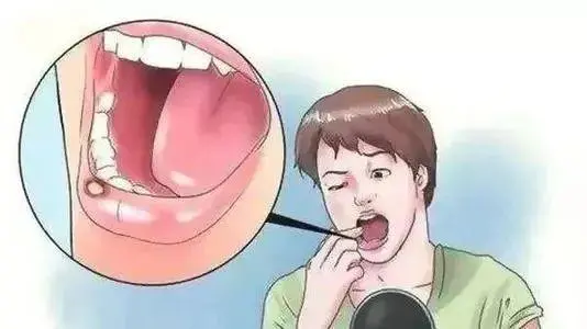 杭州御和堂中医：哪些口腔疾病会导致口腔癌。